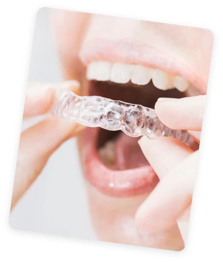 Aligners